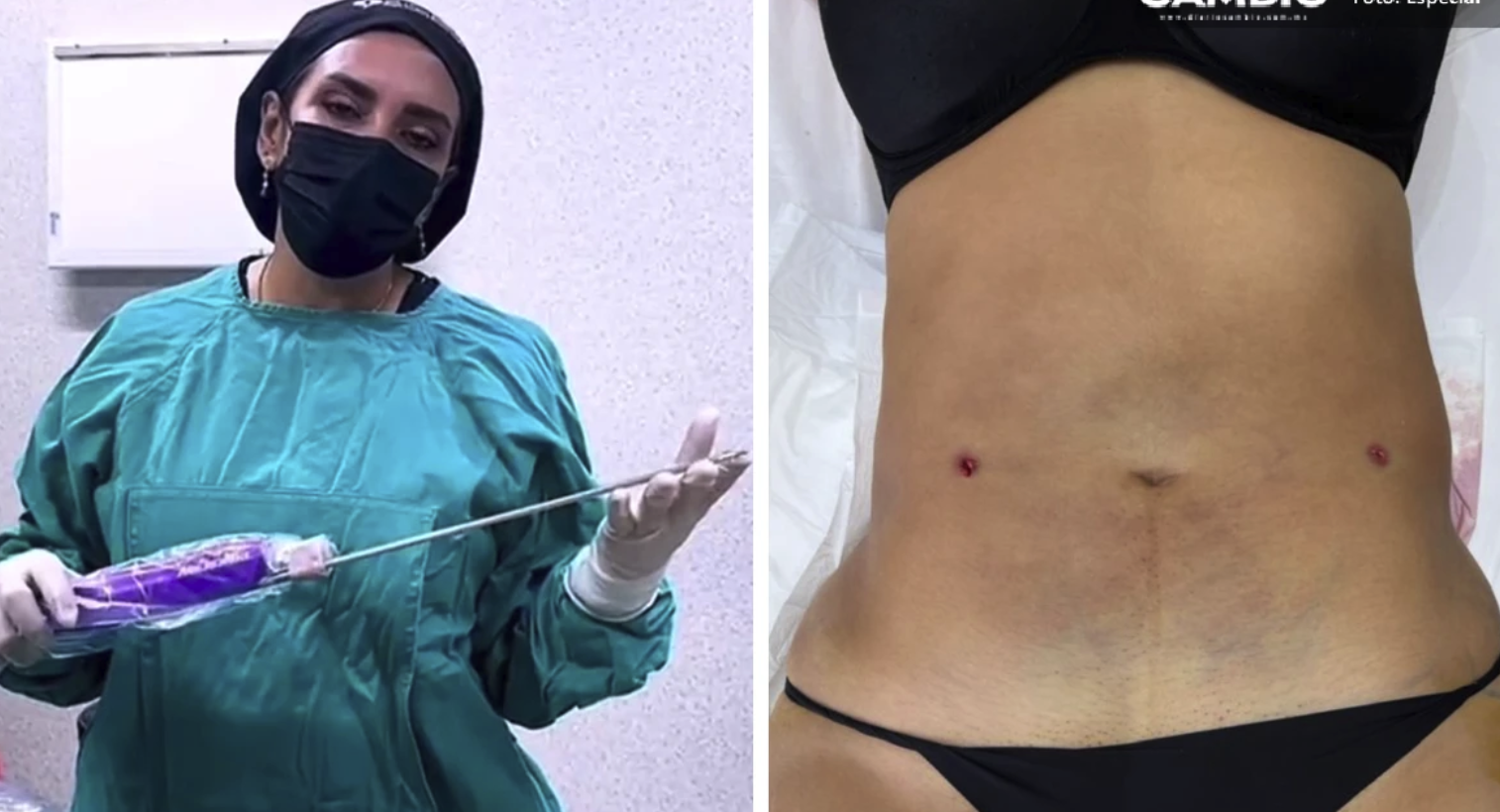 “Chips sexuales” y liposucciones en 14 mil pesos: el polémico catálogo de la clínica Detox donde desapareció Blanca Adriana